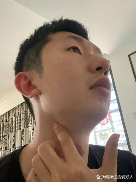 淋巴结肿大图片大全_正常淋巴结长什么样