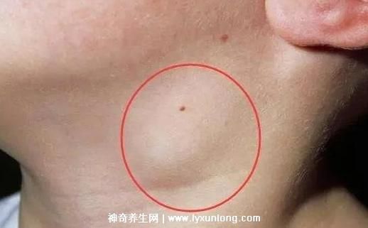 淋巴结肿大图片大全_正常淋巴结长什么样