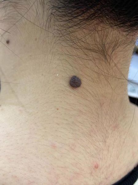 瘊子图片大全_瘊子初期症状图片