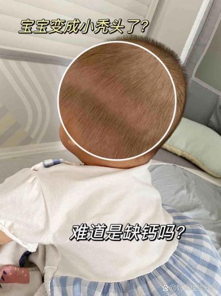 四个月宝宝枕秃怎么办_宝宝枕秃是缺钙吗
