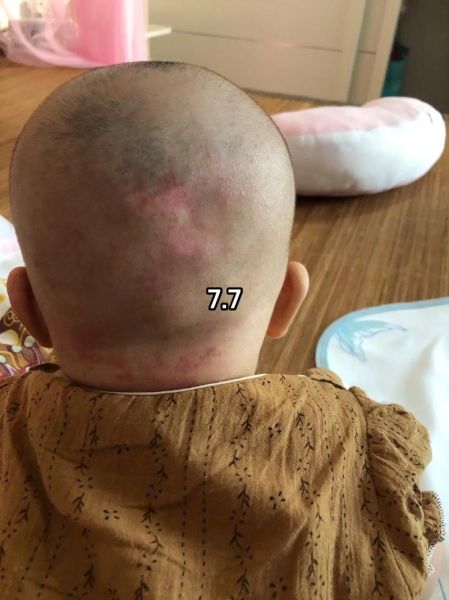 四个月宝宝枕秃怎么办_宝宝枕秃是缺钙吗