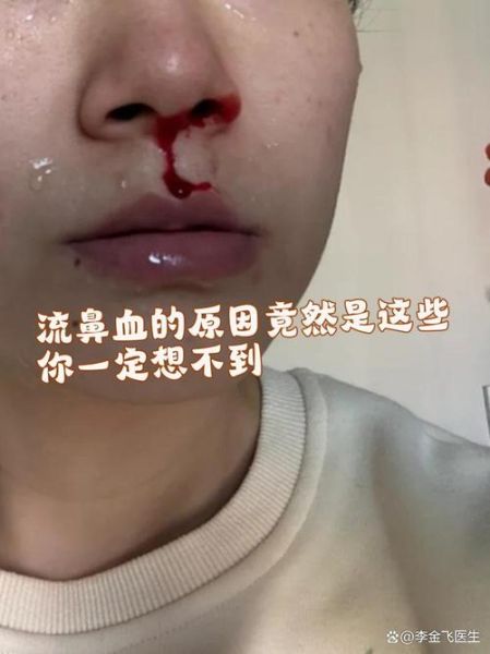 梦到鼻子出血是什么意思_梦到鼻子出血预示什么