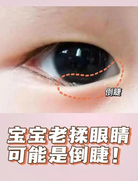 宝宝倒睫毛怎么处理_婴儿倒睫会自愈吗