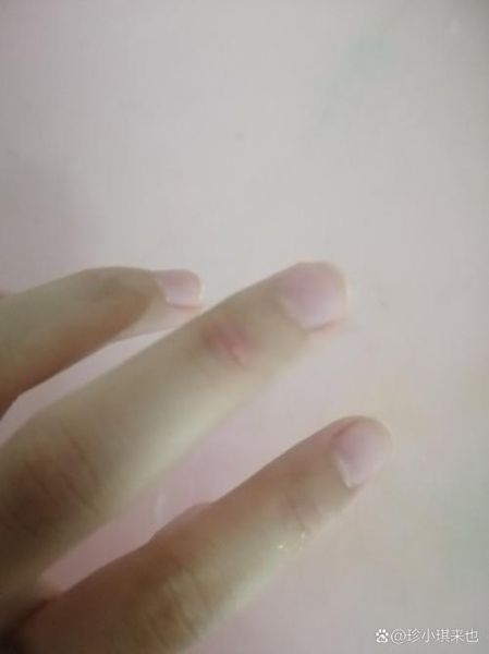 梦到手破了是什么意思_梦见手破皮了代表什么