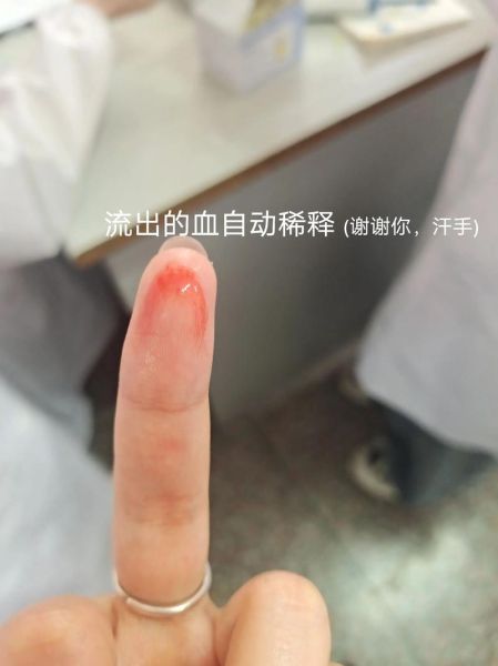 梦到很多针是什么意思_梦见针扎手出血解析