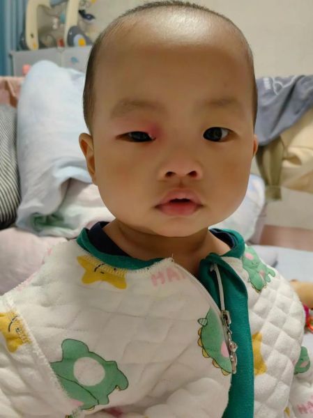 新生儿眼睛肿了怎么办_宝宝眼睛肿多久能消