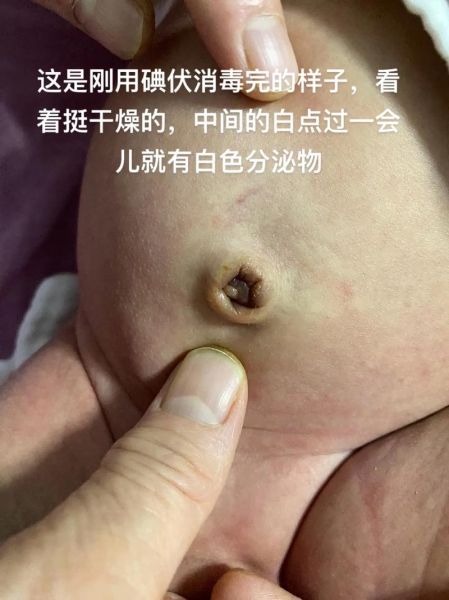 宝宝十天了脐带还没掉_脐带脱落延迟怎么办