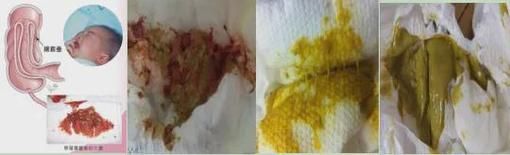 肠套叠宝宝大便图片_果酱样便是唯一信号吗