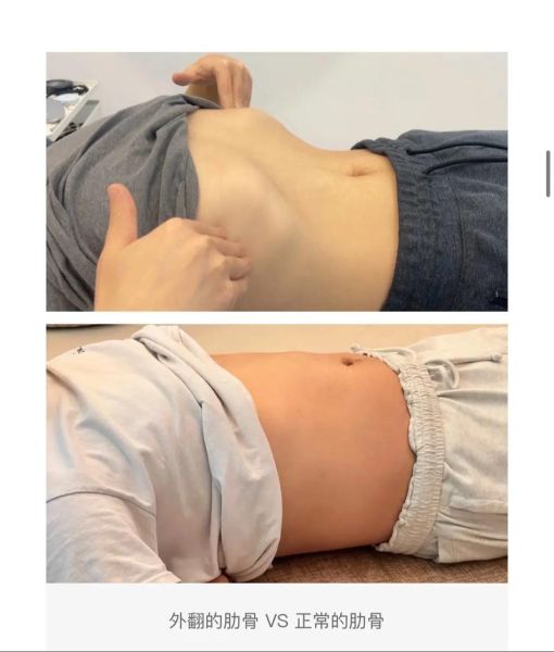 宝宝肋骨外翻怎么办_如何判断肋骨外翻