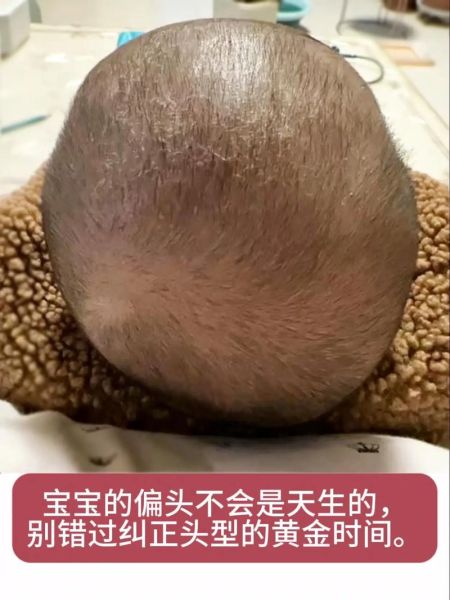 宝宝后脑勺左右不对称_会不会影响智力