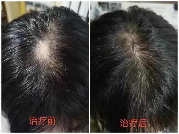 秃顶图片大全_秃顶怎么办