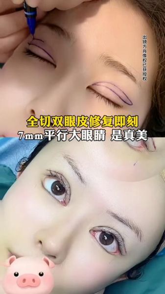 梦到做双眼皮_梦见割双眼皮是什么意思