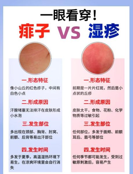 宝宝痱子图片_怎么快速消退