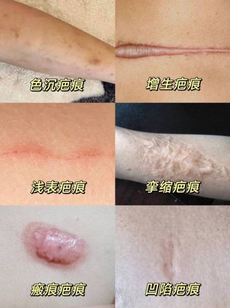 伤痕图片大全_如何分辨新旧伤疤