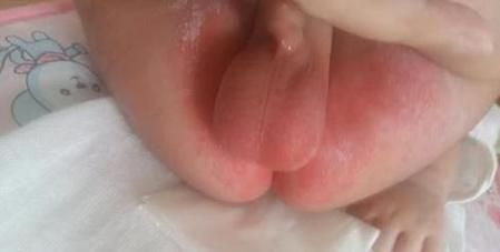 宝宝尿口有点红怎么办_宝宝尿道口红肿原因