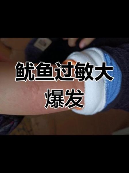 宝宝吃鱼过敏怎么办_宝宝吃鱼过敏症状