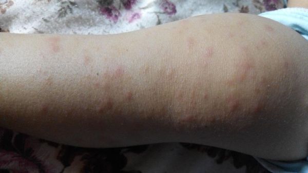 宝宝吃鱼过敏怎么办_宝宝吃鱼过敏症状