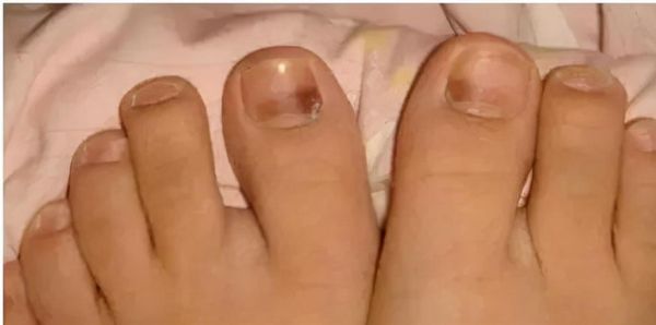 灰指甲图片大全_初期症状有哪些