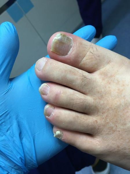 灰指甲图片大全_初期症状有哪些