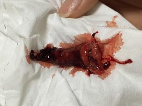 梦到自己打胎_意味着什么