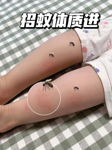 宝宝被蚊子咬了怎么办_如何快速止痒消肿