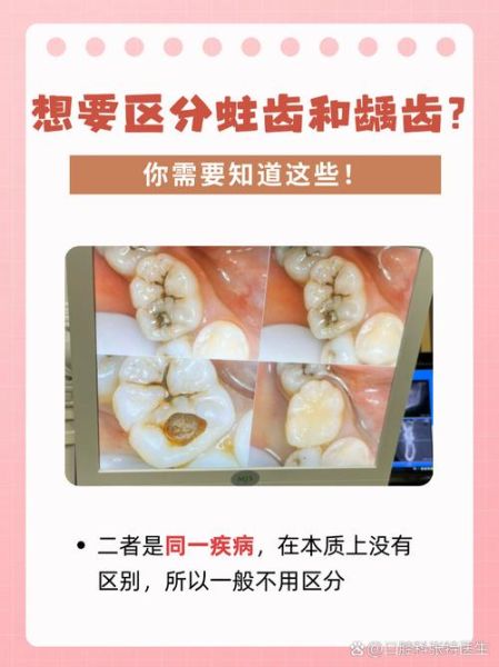 牙齿图片大全图_如何辨别龋齿与牙结石