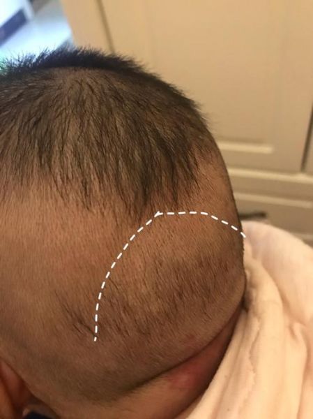 宝宝后脑勺有凹槽正常吗_婴儿头骨凹陷原因