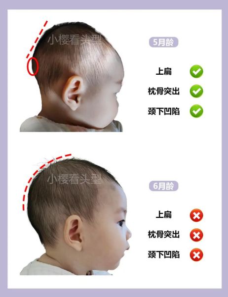 宝宝后脑勺有凹槽正常吗_婴儿头骨凹陷原因