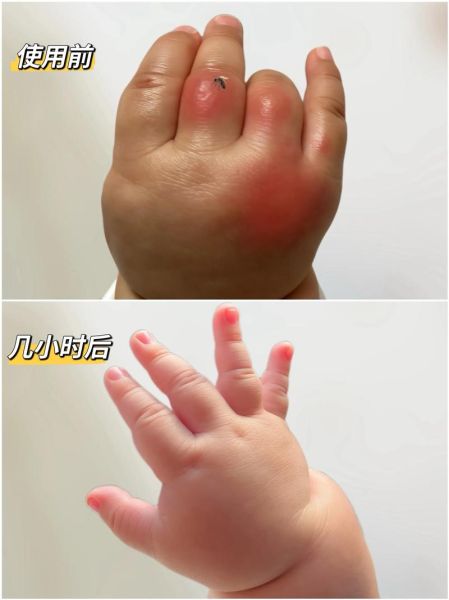 宝宝被蚊子咬了涂什么_止痒消肿用什么好