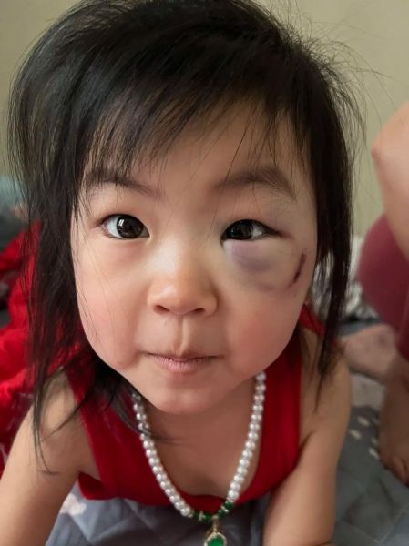 宝宝眼下发青怎么回事_宝宝眼下发青正常吗