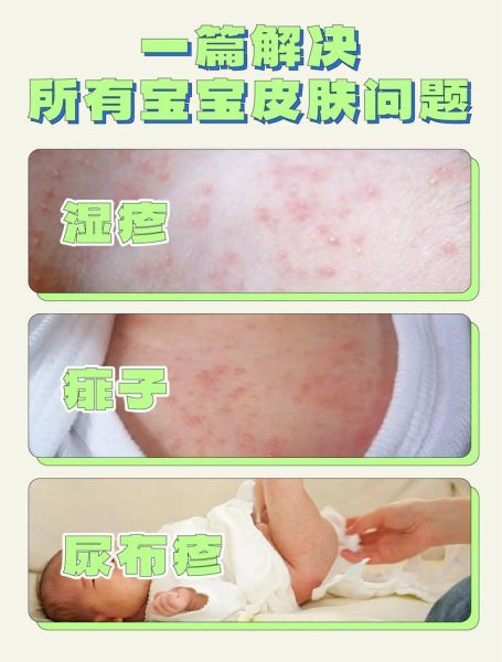 四个月宝宝热疹怎么办_婴儿热疹护理方法