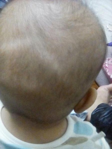 宝宝头后面骨头突出来正常吗_宝宝后脑勺骨头突出怎么办