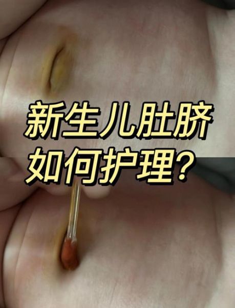 宝宝肚脐出水怎么回事_肚脐渗液怎么办