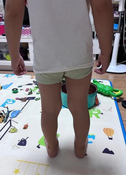 宝宝小腿弯曲正常吗_需要矫正吗