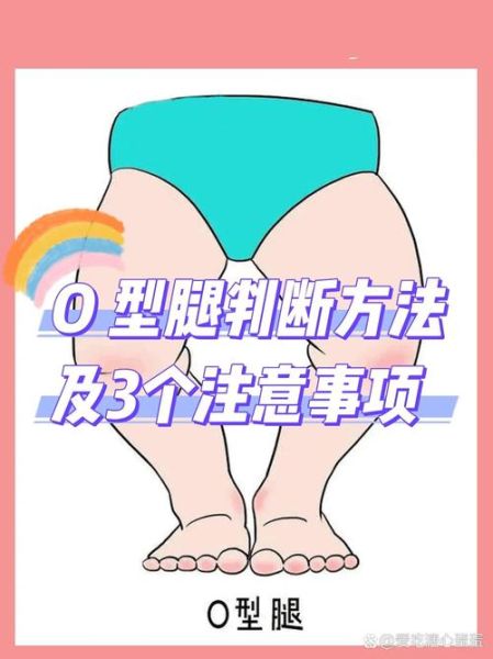 宝宝罗圈腿图片_如何判断是否O型腿