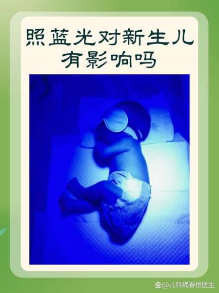宝宝黄疸23点多怎么办_黄疸23需要照蓝光吗