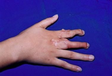 梦到手指断了_梦见手指断了是什么意思