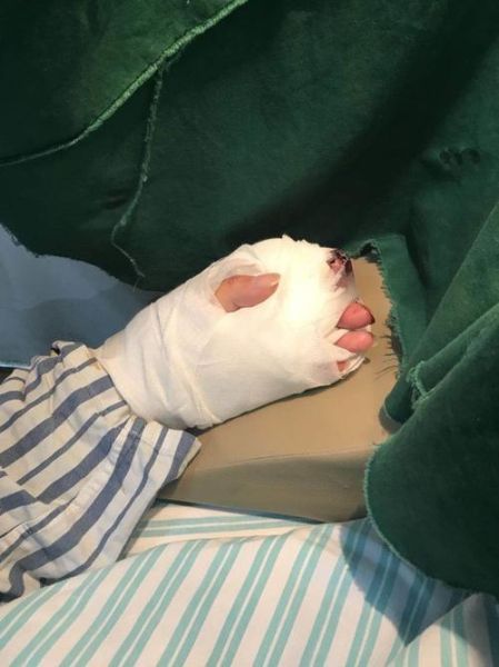 梦到手指断了_梦见手指断了是什么意思