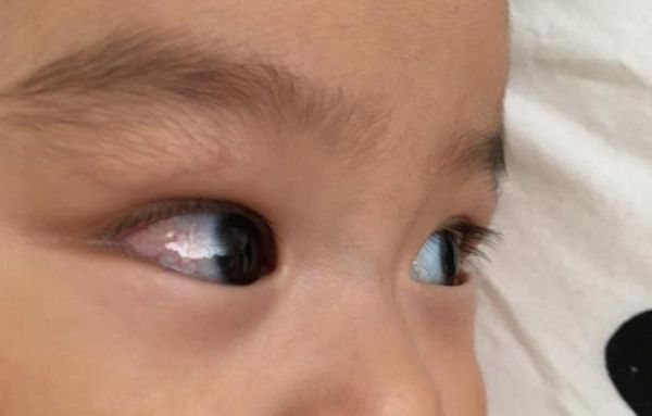 两个月宝宝眼白发蓝正常吗_婴儿眼白发蓝原因