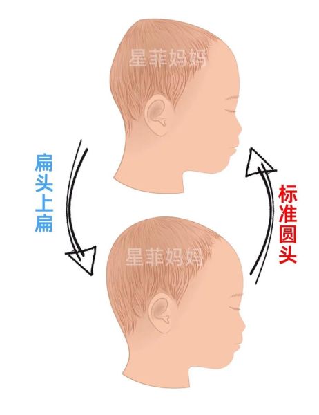 宝宝头睡扁了怎么办_如何矫正扁头