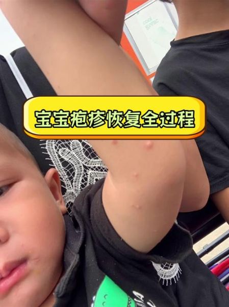 一岁宝宝病毒性感冒症状_多久能好