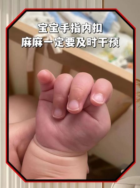 四个月宝宝拇指内扣正常吗_如何纠正