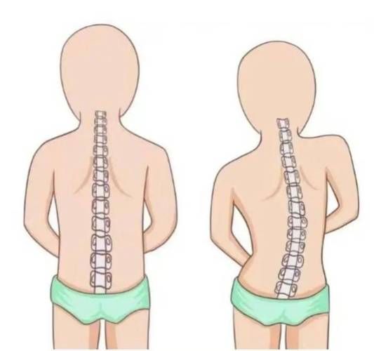 宝宝脊椎弯曲图片_婴儿脊柱侧弯怎么判断