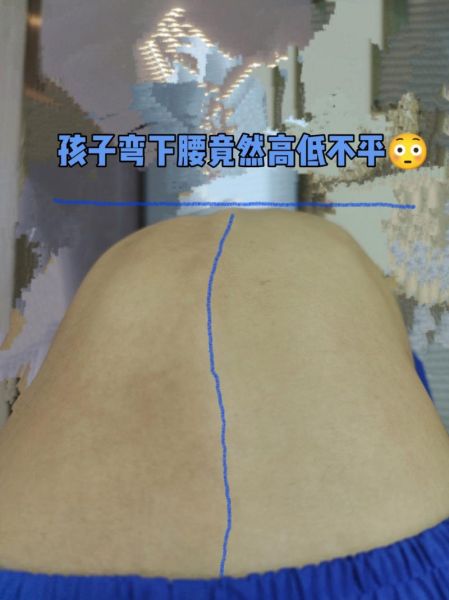 宝宝脊椎弯曲图片_婴儿脊柱侧弯怎么判断