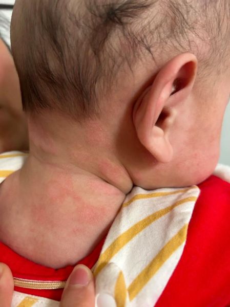 宝宝过敏图片_如何辨别食物过敏还是湿疹